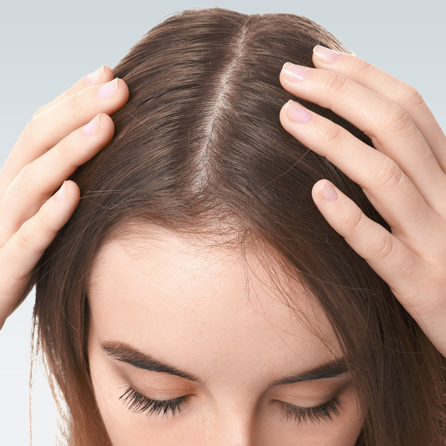 Female-Pattern Hair Loss