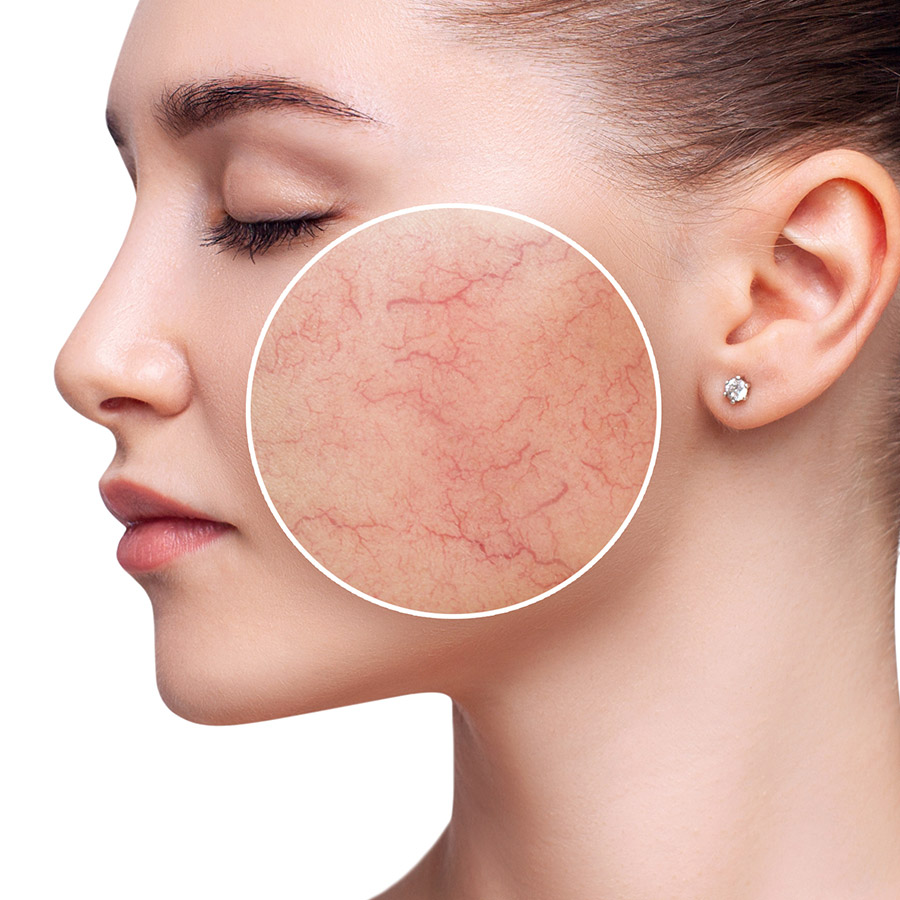 Rosacea