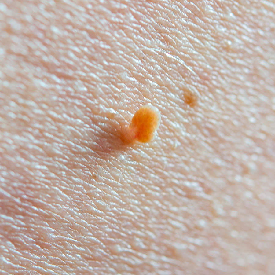 Skin Tag Removal