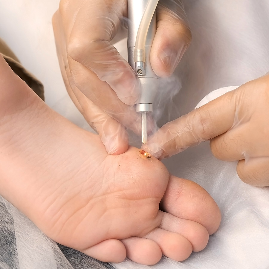 Wart Removal